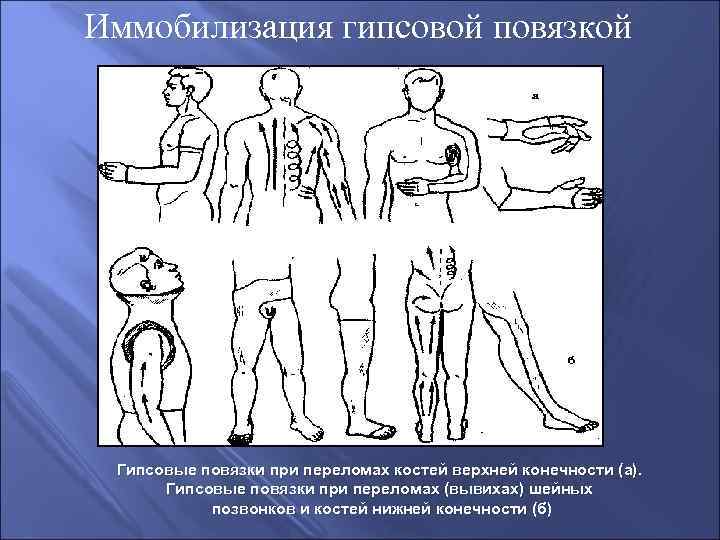 Гипсовые повязки при переломах костей