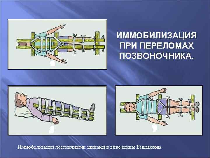 Иммобилизация поясничного отдела. Перелом позвоночника иммобилизация. Шина при переломе позвоночника. Иммобилизация при переломе позвоночника. Типы переломов позвоночника.