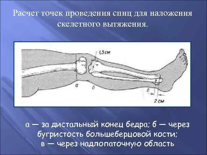 Закрытый перелом бедренной кости карта вызова