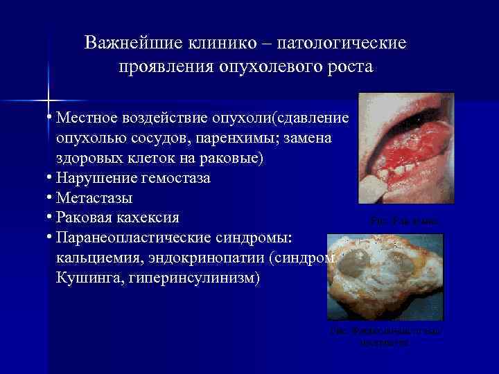 Важнейшие клинико – патологические проявления опухолевого роста • Местное воздействие опухоли(сдавление опухолью сосудов, паренхимы;