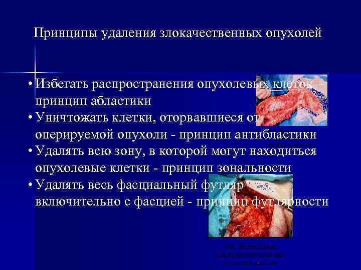 Принципы удаления злокачественных опухолей • Избегать распространения опухолевых клеток – принцип абластики • Уничтожать