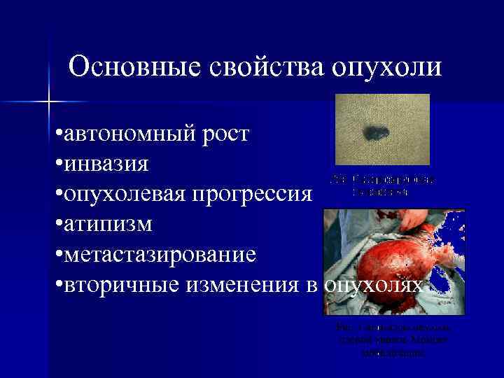 Основные свойства опухоли • автономный рост • инвазия • опухолевая прогрессия • атипизм •