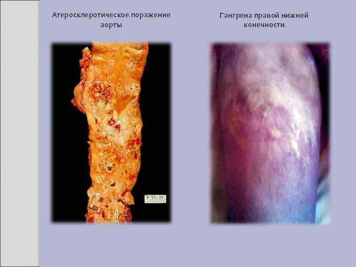Атеросклеротическое поражение аорты Гангрена правой нижней конечности. 