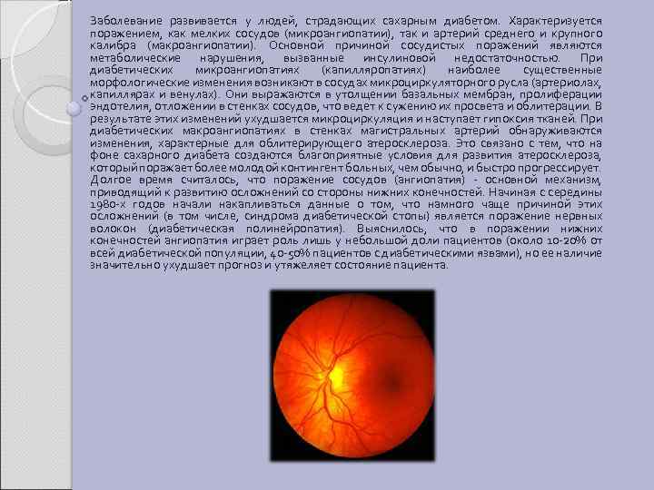 Заболевание развивается у людей, страдающих сахарным диабетом. Характеризуется поражением, как мелких сосудов (микроангиопатии), так
