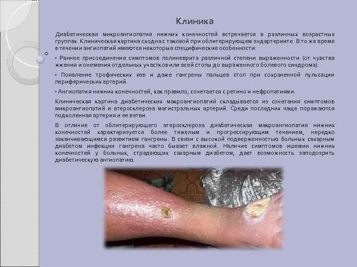 Клиника Диабетическая микроангиопатия нижних конечностей встречается в различных возрастных группах. Клиническая картина сходна с