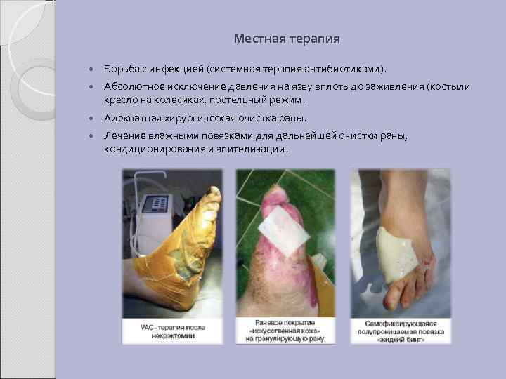 Местная терапия Борьба с инфекцией (системная терапия антибиотиками). Абсолютное исключение давления на язву вплоть