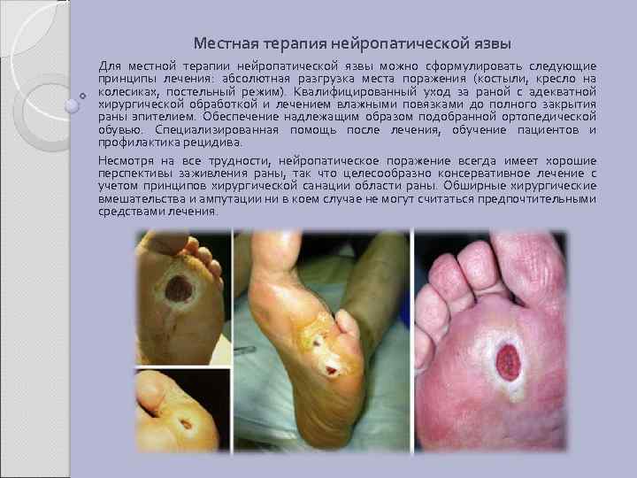 Местная терапия нейропатической язвы Для местной терапии нейропатической язвы можно сформулировать следующие принципы лечения: