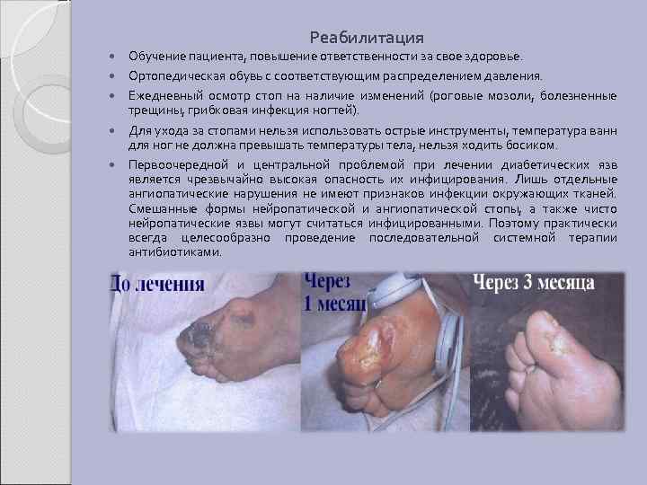 Реабилитация Обучение пациента, повышение ответственности за свое здоровье. Ортопедическая обувь с соответствующим распределением давления.