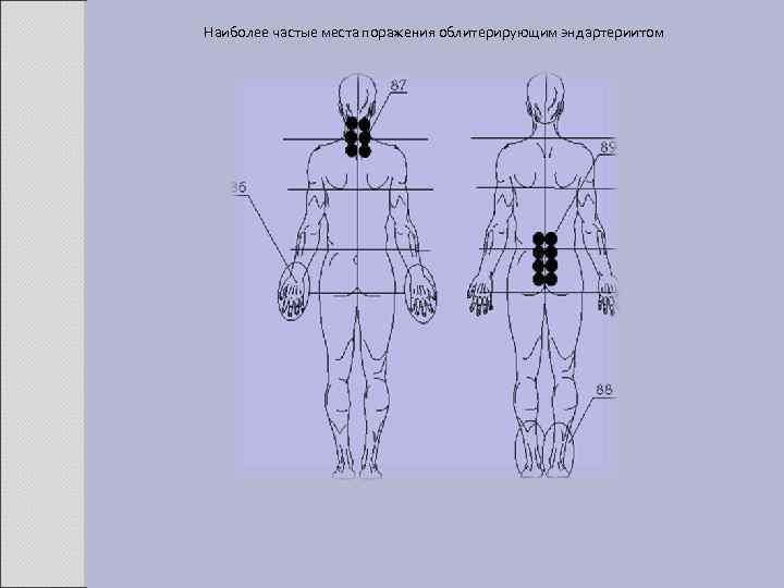 Наиболее частые места поражения облитерирующим эндартериитом 
