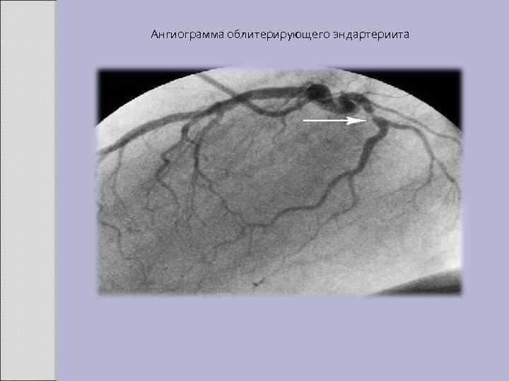Ангиограмма облитерирующего эндартериита 