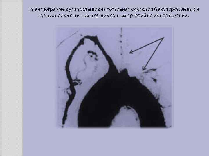 На ангиограмме дуги аорты видна тотальная окклюзия (закупорка) левых и правых подключичных и общих
