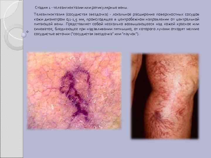  Стадия 1 - телеангиэктазии или ретикулярные вены. Телеангиэктазия (сосудистая звездочка) - локальное расширение