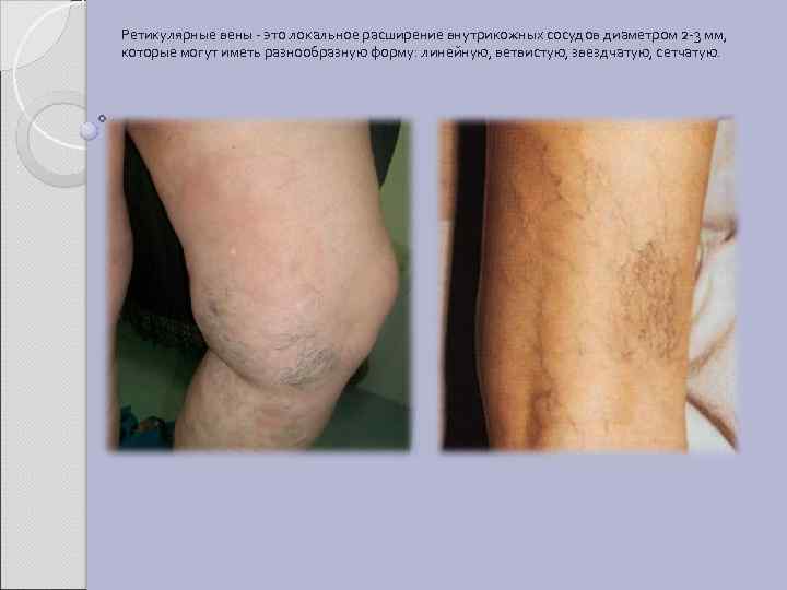 Ретикулярные вены - это локальное расширение внутрикожных сосудов диаметром 2 -3 мм, которые могут
