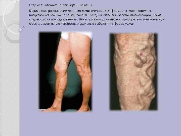 Стадия 2 - варикозно-расширенные вены. Варикозное расширение вен - это патологическая деформация поверхностных (подкожных)
