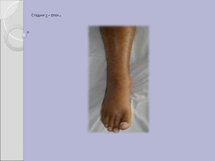 Стадия 3 – отек . 
