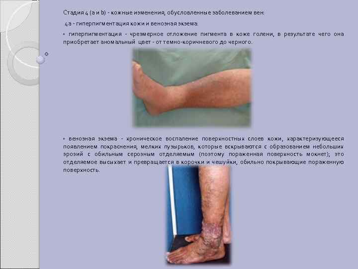 Стадия 4 (а и b) - кожные изменения, обусловленные заболеванием вен: 4 а -