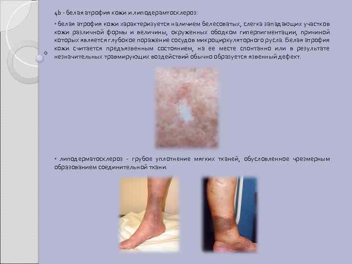 4 b - белая атрофия кожи и липодерамтосклероз: • белая атрофия кожи характеризуется наличием