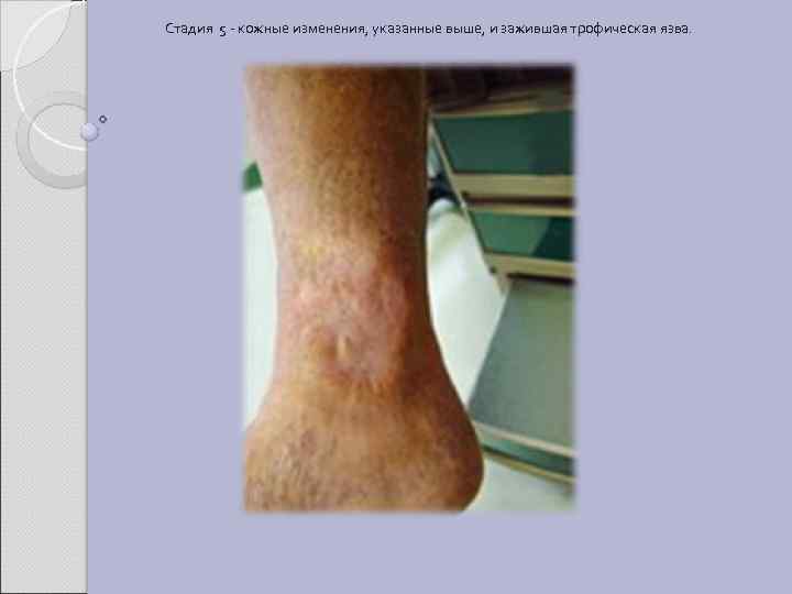 Стадия 5 - кожные изменения, указанные выше, и зажившая трофическая язва. 
