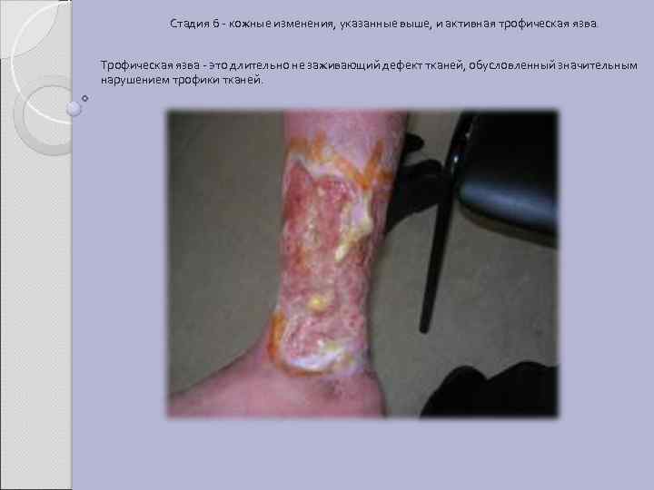 Стадия 6 - кожные изменения, указанные выше, и активная трофическая язва. Трофическая язва -
