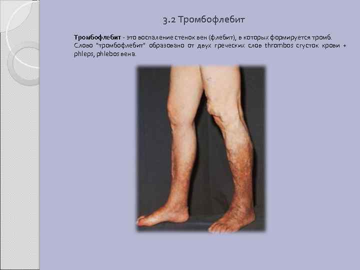 3. 2 Тромбофлебит - это воспаление стенок вен (флебит), в которых формируется тромб. Слово