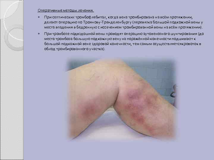 Оперативные методы лечения. При септических тромбофлебитах, когда вена тромбирована на всём протяжении, делают операцию