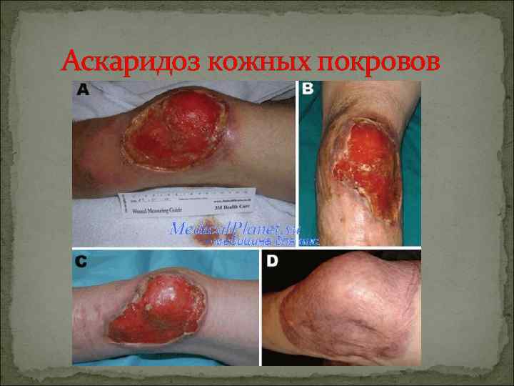 Аскаридоз кожных покровов 