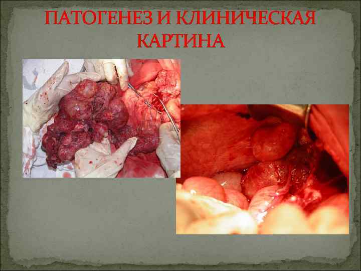 ПАТОГЕНЕЗ И КЛИНИЧЕСКАЯ КАРТИНА 