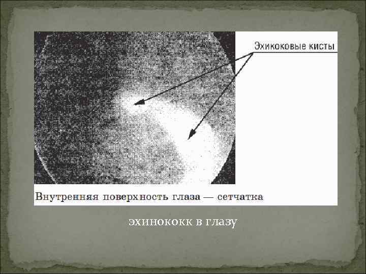 эхинококк в глазу 