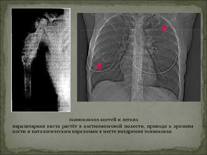 эхинококкоз костей и легких паразитарная киста растёт в костномозговой полости, приводя к эрозиям кости