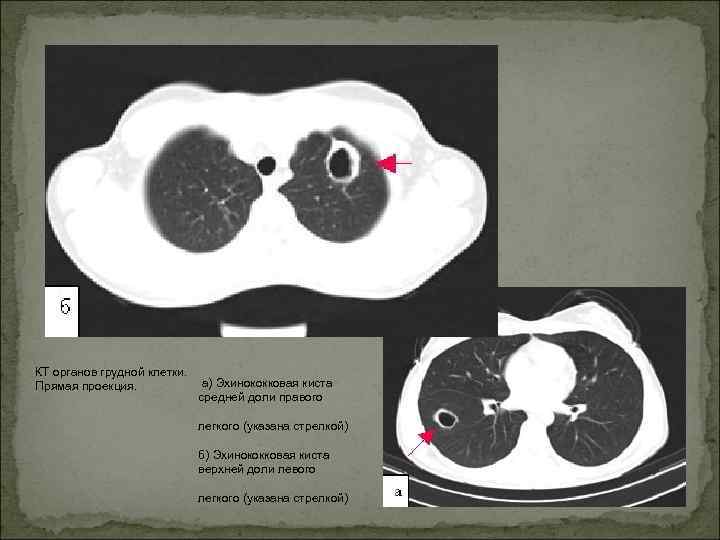 КТ органов грудной клетки. Прямая проекция. а) Эхинококковая киста средней доли правого легкого (указана