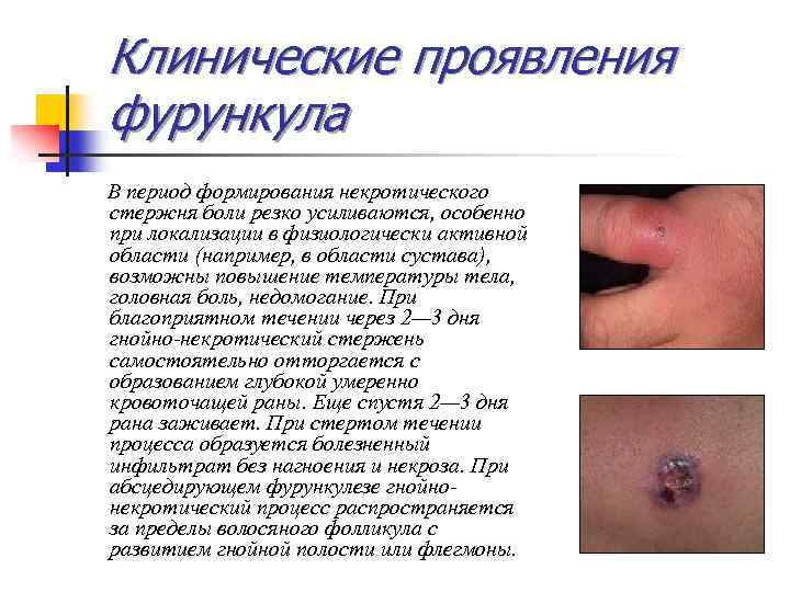 Клинические проявления фурункула В период формирования некротического стержня боли резко усиливаются, особенно при локализации