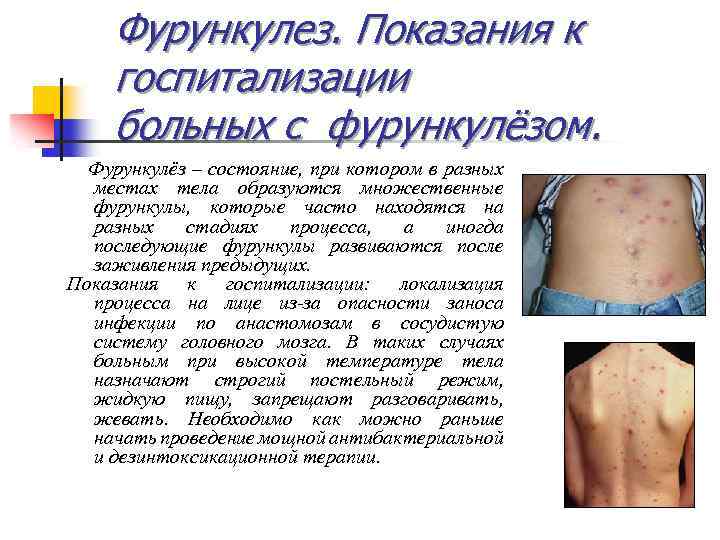 Фурункулез. Показания к госпитализации больных с фурункулёзом. Фурункулёз – состояние, при котором в разных