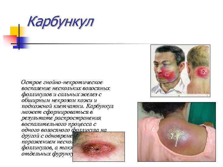 Карбункул Острое гнойно-некротическое воспаление нескольких волосяных фолликулов и сальных желез с обширным некрозом кожи