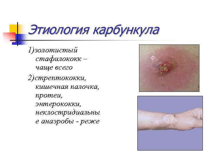 Этиология карбункула 1)золотистый стафилококк – чаще всего 2)стрептококки, кишечная палочка, протеи, энтерококки, неклостридиальны е