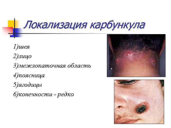 Локализация карбункула 1)шея 2)лицо 3)межлопаточная область 4)поясница 5)ягодицы 6)конечности - редко 
