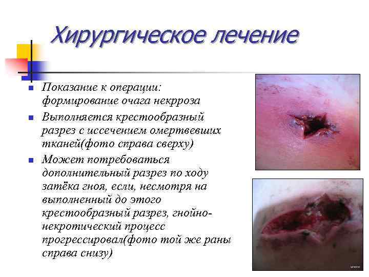 Хирургическое лечение n n n Показание к операции: формирование очага некрроза Выполняется крестообразный разрез