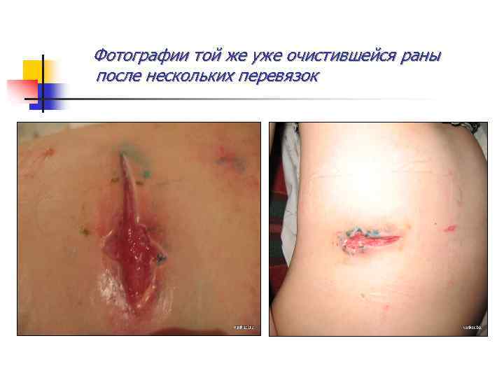 Фотографии той же уже очистившейся раны после нескольких перевязок 