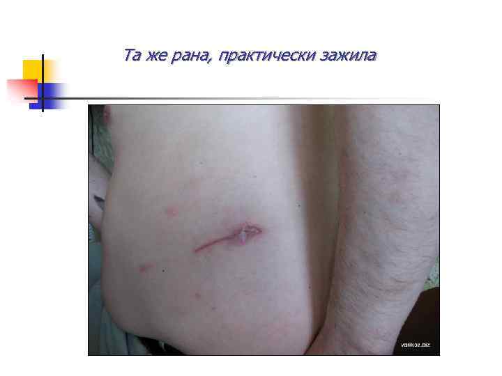  Та же рана, практически зажила 