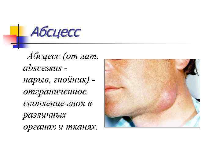 Абсцесс (от лат. abscessus - нарыв, гнойник) - отграниченное скопление гноя в различных органах