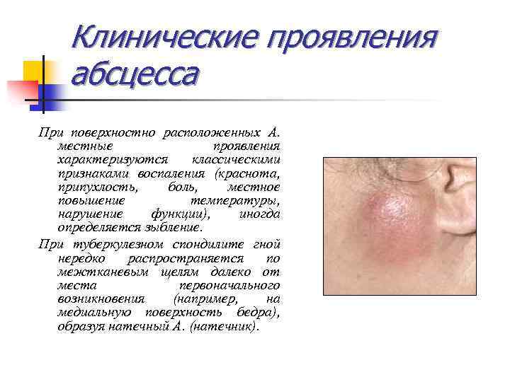 Клинические проявления абсцесса При поверхностно расположенных А. местные проявления характеризуются классическими признаками воспаления (краснота,