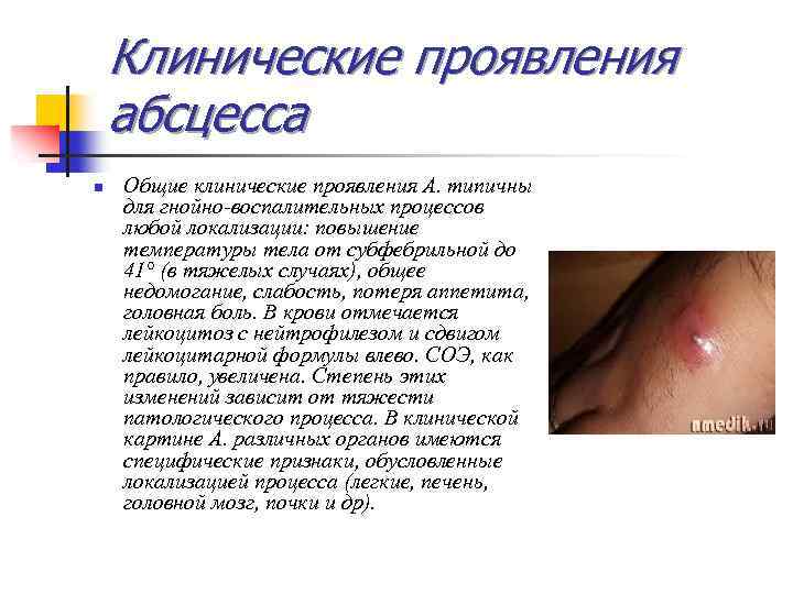 Клинические проявления абсцесса n Общие клинические проявления А. типичны для гнойно-воспалительных процессов любой локализации: