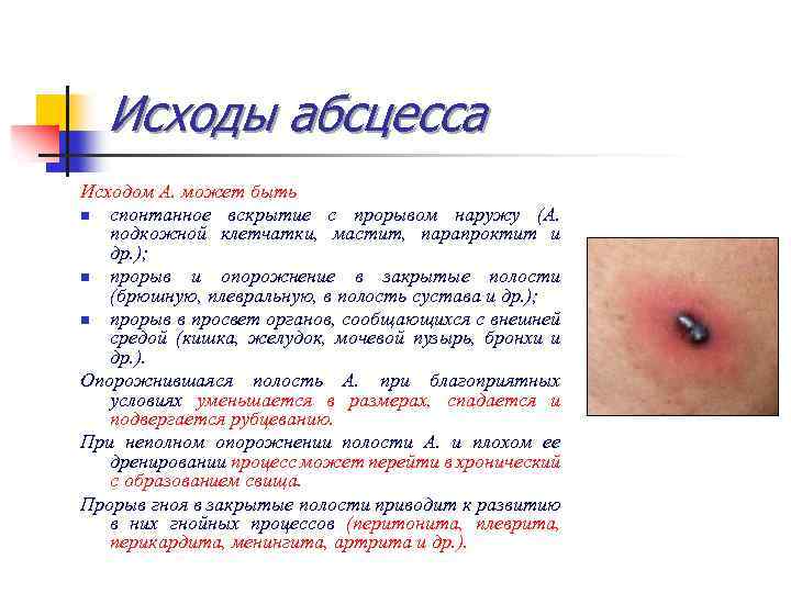 Исходы абсцесса Исходом А. может быть n спонтанное вскрытие с прорывом наружу (А. подкожной
