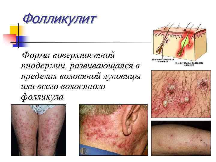 Фолликулит Форма поверхностной пиодермии, развивающаяся в пределах волосяной луковицы или всего волосяного фолликула 