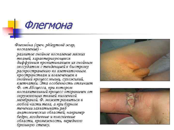 Флегмона Флегмо на (греч. phlegmonē жар, воспаление) - разлитое гнойное воспаление мягких тканей, характеризующееся