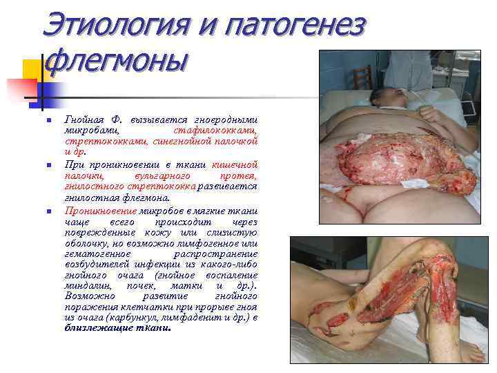 Этиология и патогенез флегмоны n n n Гнойная Ф. вызывается гноеродными микробами, стафилококками, стрептококками,