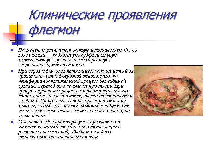 Клинические проявления флегмон n n n По течению различают острую и хроническую Ф. ,