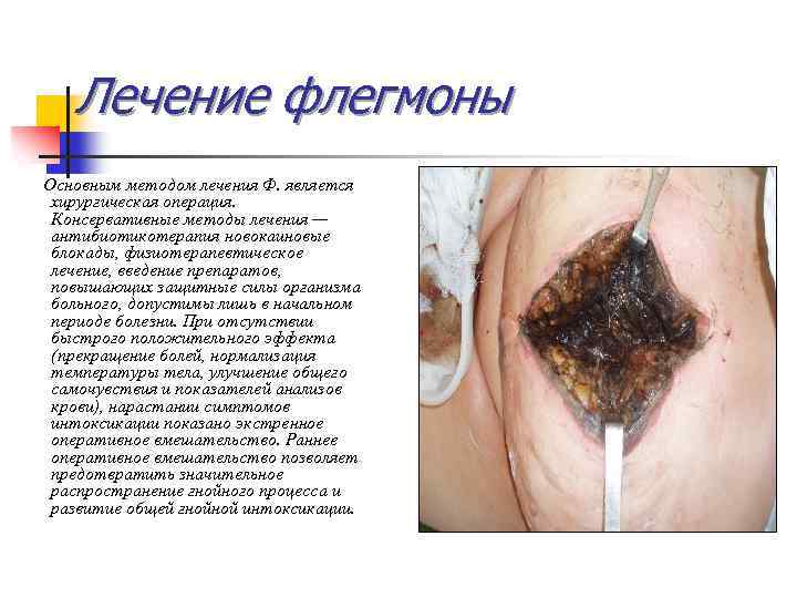 Лечение флегмоны Основным методом лечения Ф. является хирургическая операция. Консервативные методы лечения — антибиотикотерапия