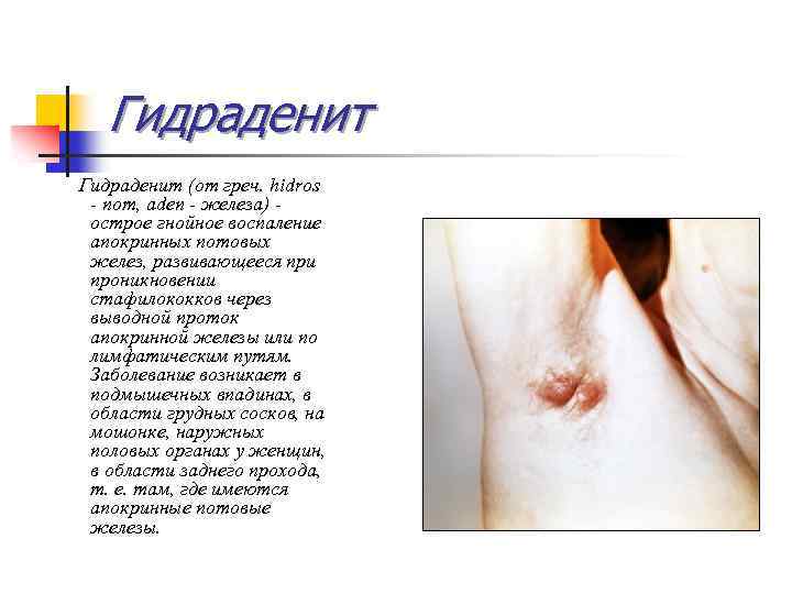 Гидраденит (от греч. hidros - пот, aden - железа) - острое гнойное воспаление апокринных