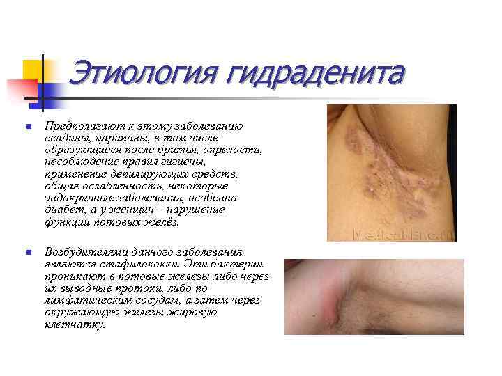 Этиология гидраденита n n Предполагают к этому заболеванию ссадины, царапины, в том числе образующиеся