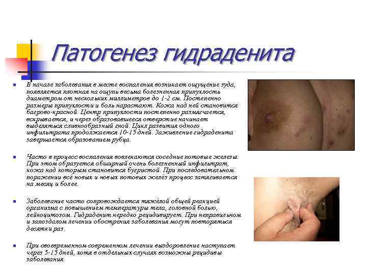 Патогенез гидраденита n n В начале заболевания в месте воспаления возникает ощущение зуда, появляется